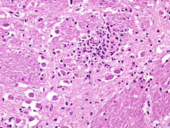 4B3 Aspergillus, unsuspected & AD (Case 4) H&E 15A