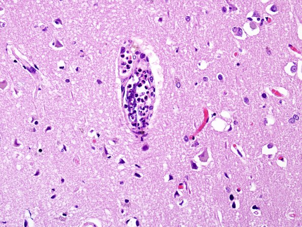 4B4 Aspergillus, unsuspected & AD (Case 4) GMS 2