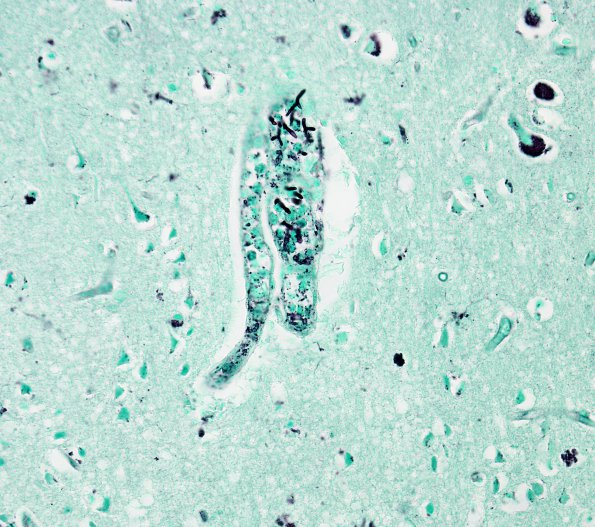 4B5 Aspergillus, unsuspected & AD (Case 4) GMS 1
