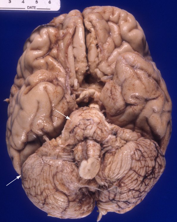 1A1 Meningoencephaltis, AIDS, Blastomycosis (Case 1) 1 copy