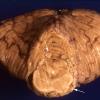 1A3 Meningoencephaltis, AIDS, Blastomycosis (Case 1) A4 copy