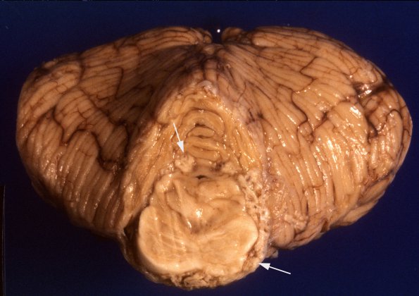 1A3 Meningoencephaltis, AIDS, Blastomycosis (Case 1) A4 copy