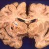 1A4 Meningoencephaltis, AIDS, Blastomycosis (Case 1) A1 copy