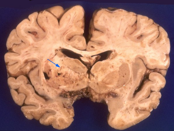 1A4 Meningoencephaltis, AIDS, Blastomycosis (Case 1) A1 copy