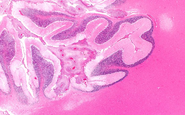 1B1 Meningoencephaltis, AIDS, Blastomycosis (Case 1) H&E 1F