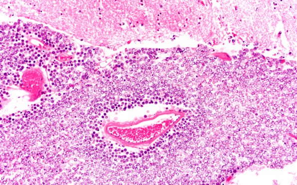 1B2 Meningoencephaltis, AIDS, Blastomycosis (Case 1) 20X H&E 1