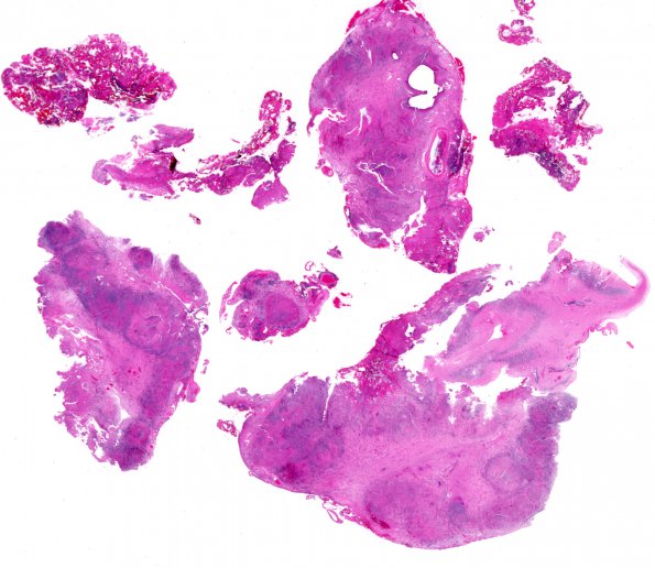 2A1 Blastomycosis (Case 2) H&E whole mount