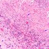 2A3 Blastomycosis (Case 2) H&E 13 copy