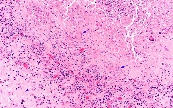 2A3 Blastomycosis (Case 2) H&E 13 copy