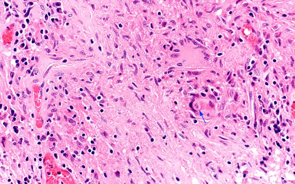 2A4 Blastomycosis (Case 2) H&E 12 copy