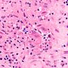 2A6 Blastomycosis (Case 2) H&E 9 copy