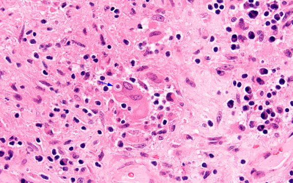 2A6 Blastomycosis (Case 2) H&E 9 copy