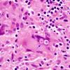 2A7 Blastomycosis (Case 2) H&E 1 copy