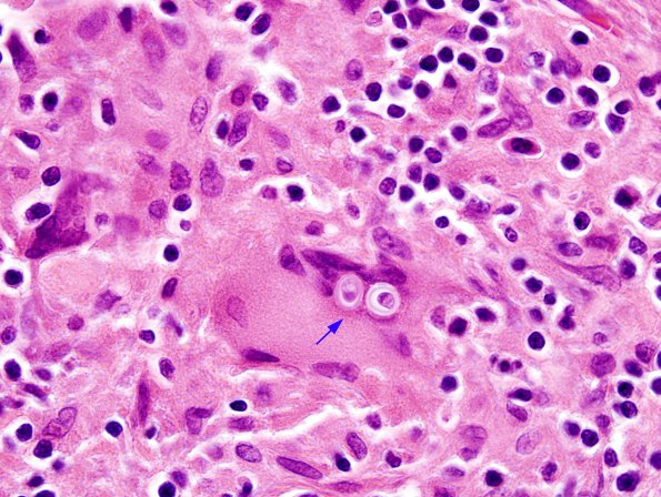 2A7 Blastomycosis (Case 2) H&E 1 copy