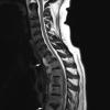 3A Blastomycosis, thoracic spine (Case 3) T2 1 - Copy copy