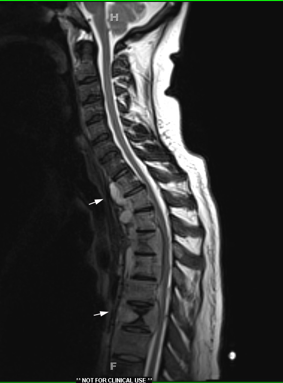 3A Blastomycosis, thoracic spine (Case 3) T2 1 - Copy copy