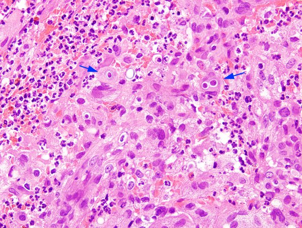 3B1 Blastomycosis (Case 3) H&E 4 copy