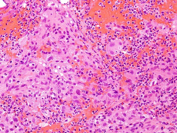 3B2 Blastomycosis (Case 3) H&E 2 copy