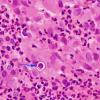 3B3 Blastomycosis (Case 3) H&E 100X 2 copy