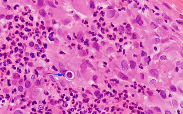 3B3 Blastomycosis (Case 3) H&E 100X 2 copy