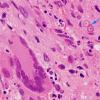 3B4 Blastomycosis (Case 3) H&E 100X 3 copy