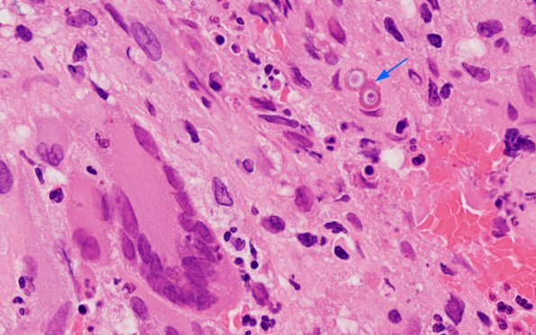 3B4 Blastomycosis (Case 3) H&E 100X 3 copy