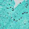 3C1 Blastomycosis (Case 3) GMS 3 copy