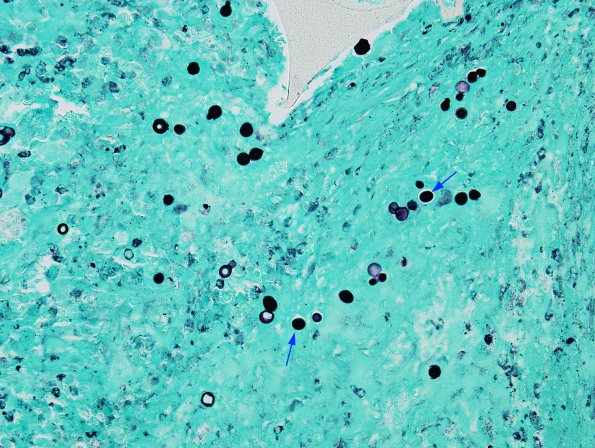 3C1 Blastomycosis (Case 3) GMS 3 copy