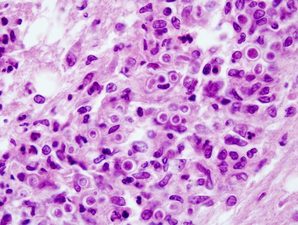 4A1 Blastomycosis (Case 4) 2