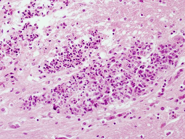 4A2 Blastomycosis (Case 4) 3