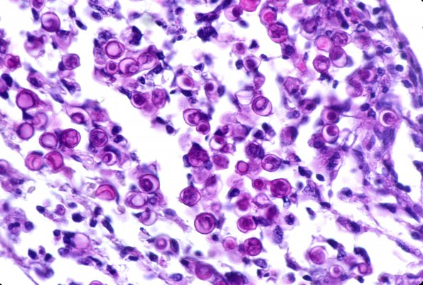 4A3 Blastomycosis (Case 4) PAS 1