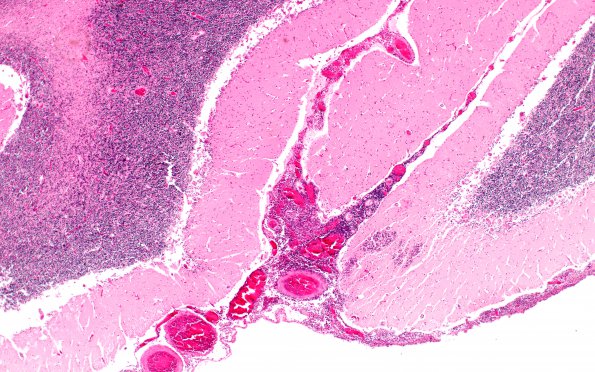 5A1 Blastomycosis (AANP DSS 1996 - Case 10) H&E 1