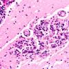 5A2 Blastomycosis (AANP DSS 1996 - Case 10) H&E 2