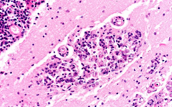 5A2 Blastomycosis (AANP DSS 1996 - Case 10) H&E 2