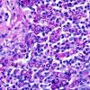 5A3 Blastomycosis (AANP DSS 1996 - Case 10) PAS 1