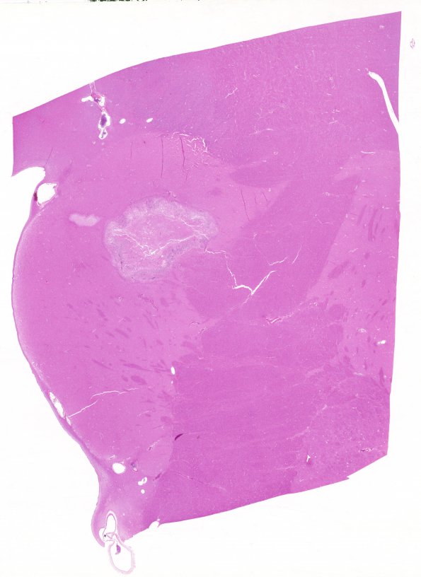 1B1 Candida (Case 1) H&E whole mount