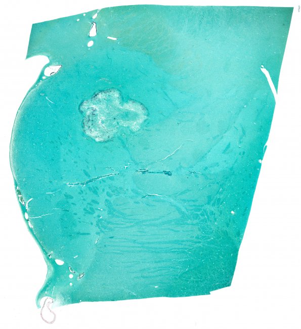 1B2 Candida (Case 1) GMS whole mount