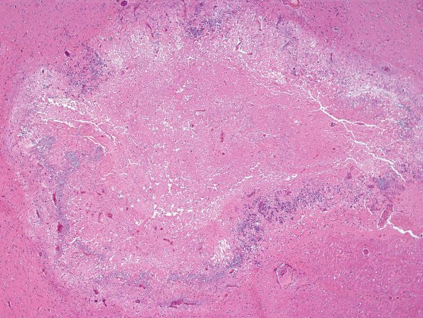 1B3 Candida (Case 1) H&E 1