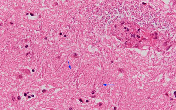 1C2 Candida (Case 1) H&E 2A copy