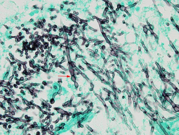 1C4 Candida (Case 1) GMS 3 copy