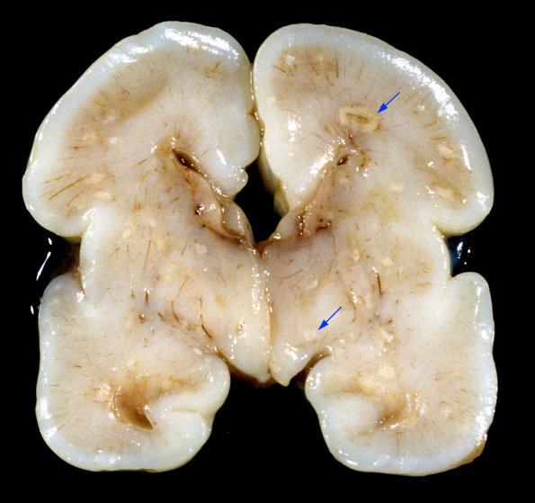 2A1 Candidiasis (Case 2) 1 copy