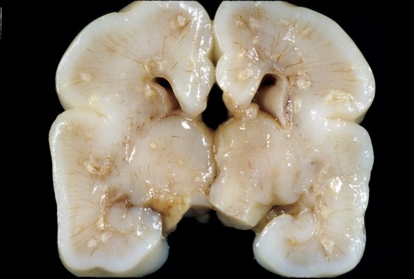 2A2 Candidiasis (Case 2)