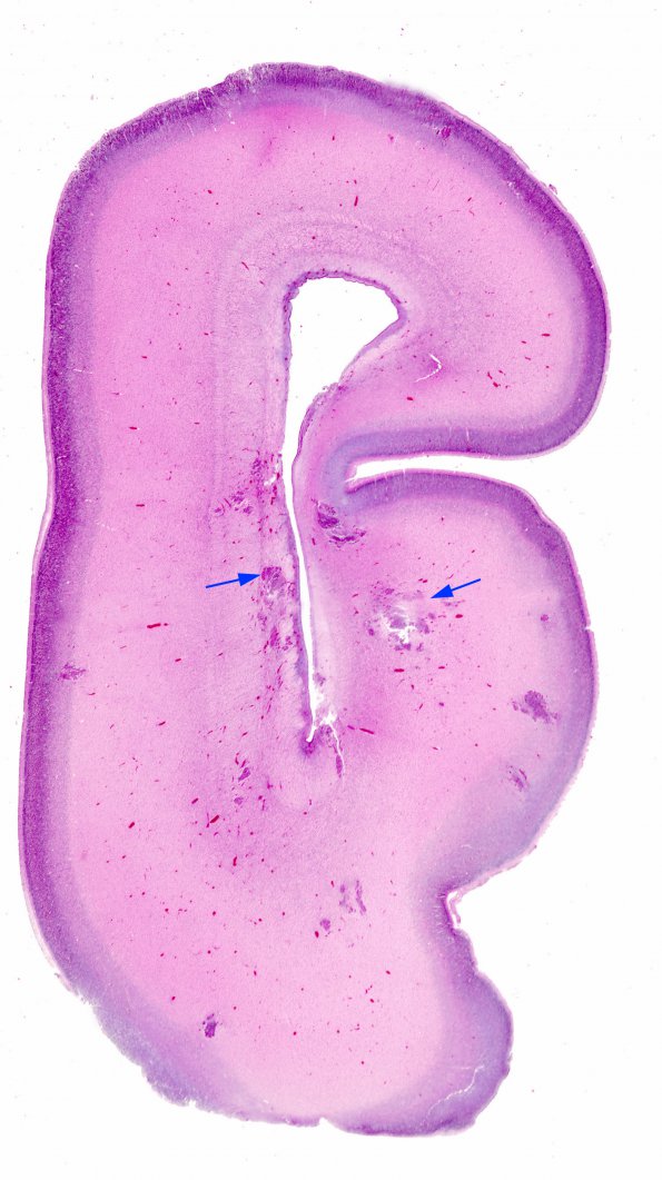 2B1 Candida (Case 2) 3 copy