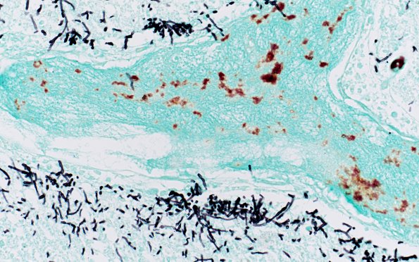 4A2 Candida (Case 4) 3