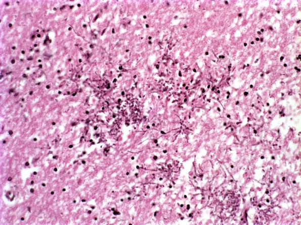 4A3 Candida (Case 4) 3 septic emboli