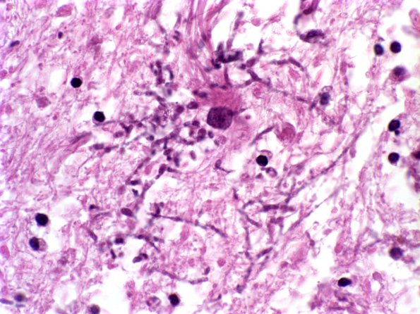 4A4 Candida (Case 4) 2 septic emboli