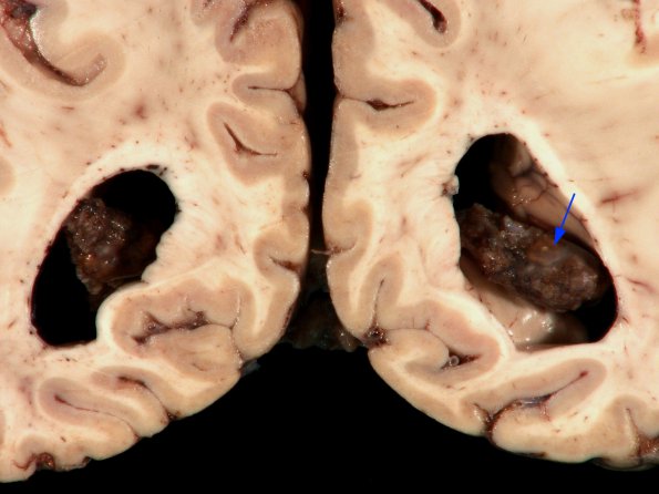 5A2 Ventriculitis & Choroid Plexitis (A10-285) 1 copy