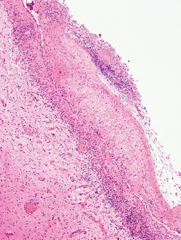 5B2 Fungal Ventriculitis (Case 5) N15 H&E 2