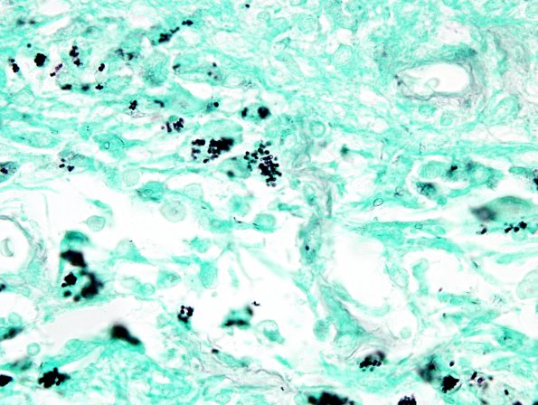 5C6 Fungal Ventriculitis (Case 5) N20 GMS 2