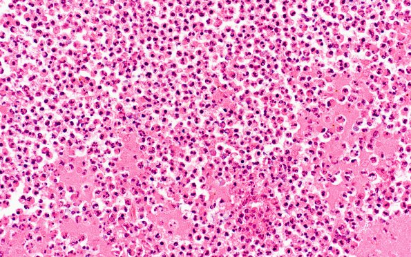 6B4 Candida (Case 6) H&E N3 6